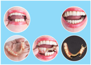 Traditional Partial Dentures